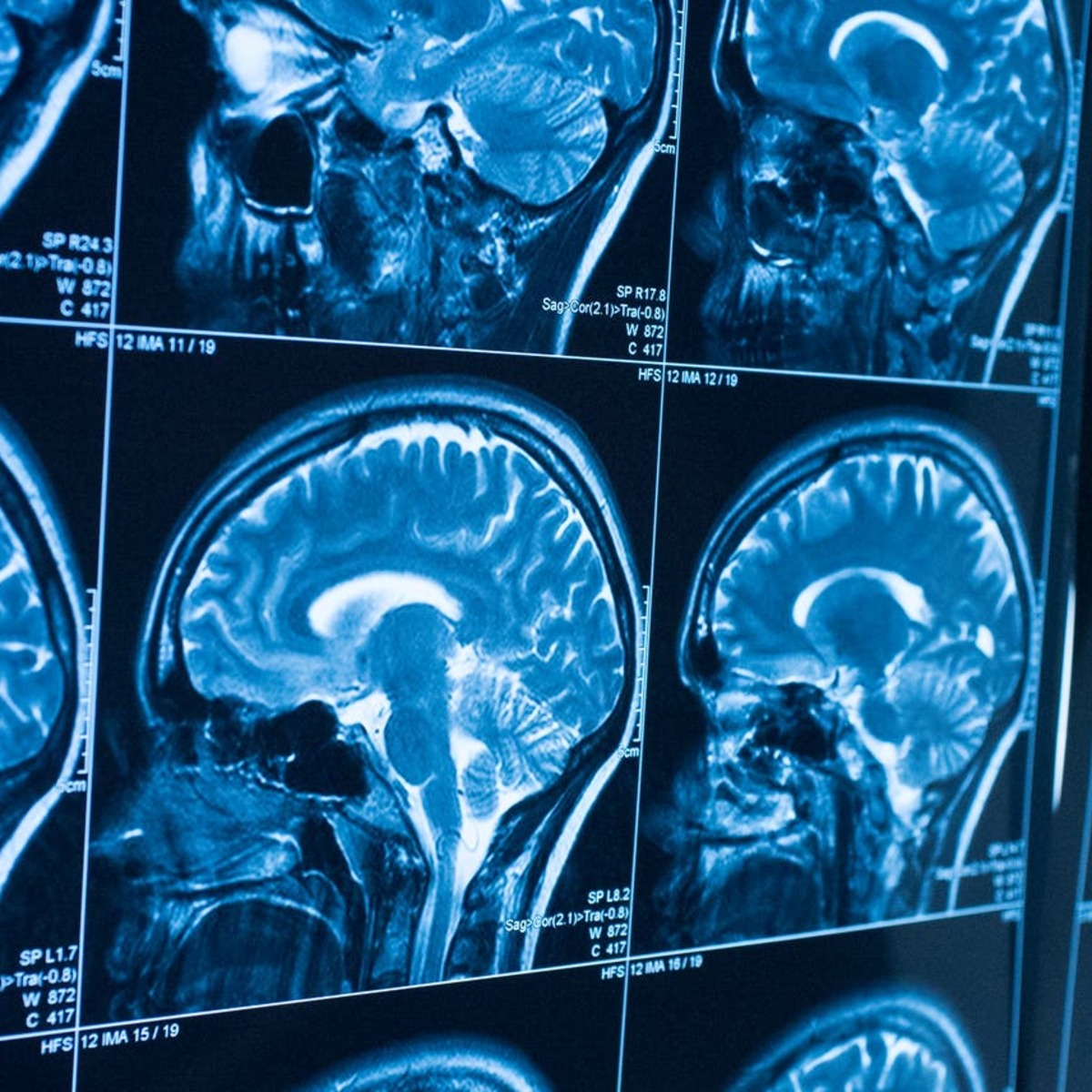 Brain Tumor MRI Image Filtering